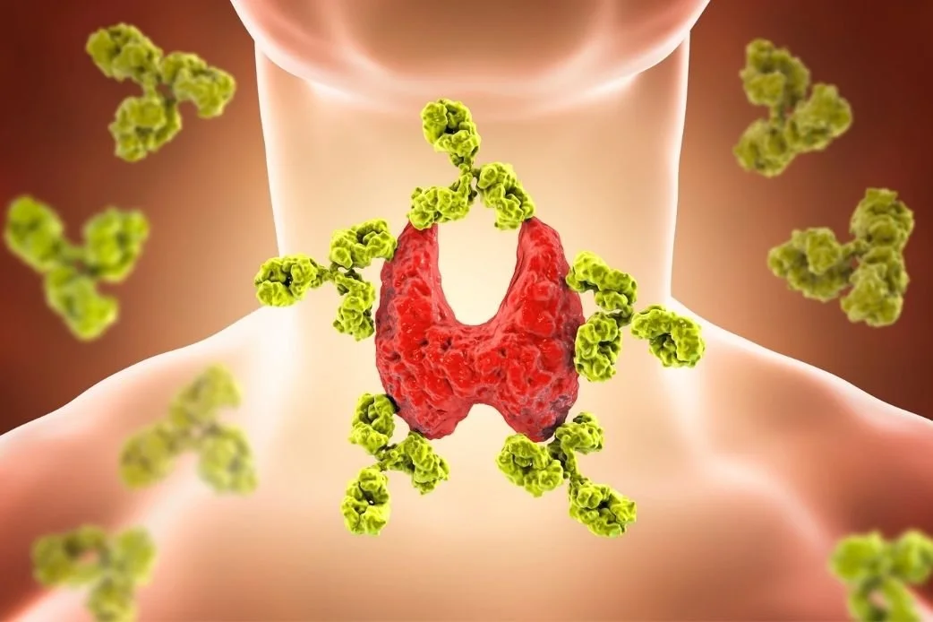 Hashimoto’s Autoimmune Hypothyroid - The Perfect Storm
