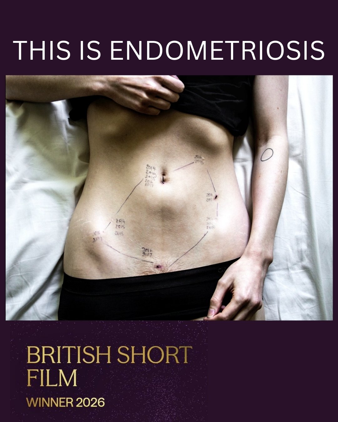 This is Endometriosis🏆 A BAFTA for endometriosis. Let that land for a moment.

"This Is Endometriosis: Finding Strength" is a volunteer-made documentary by Georgie Wileman and Matt Houghton &amp; won Best British Short Film at the BAFTAs. 