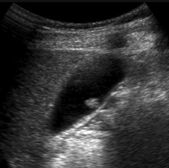 Incidentaloma: Gallbladder Polyps