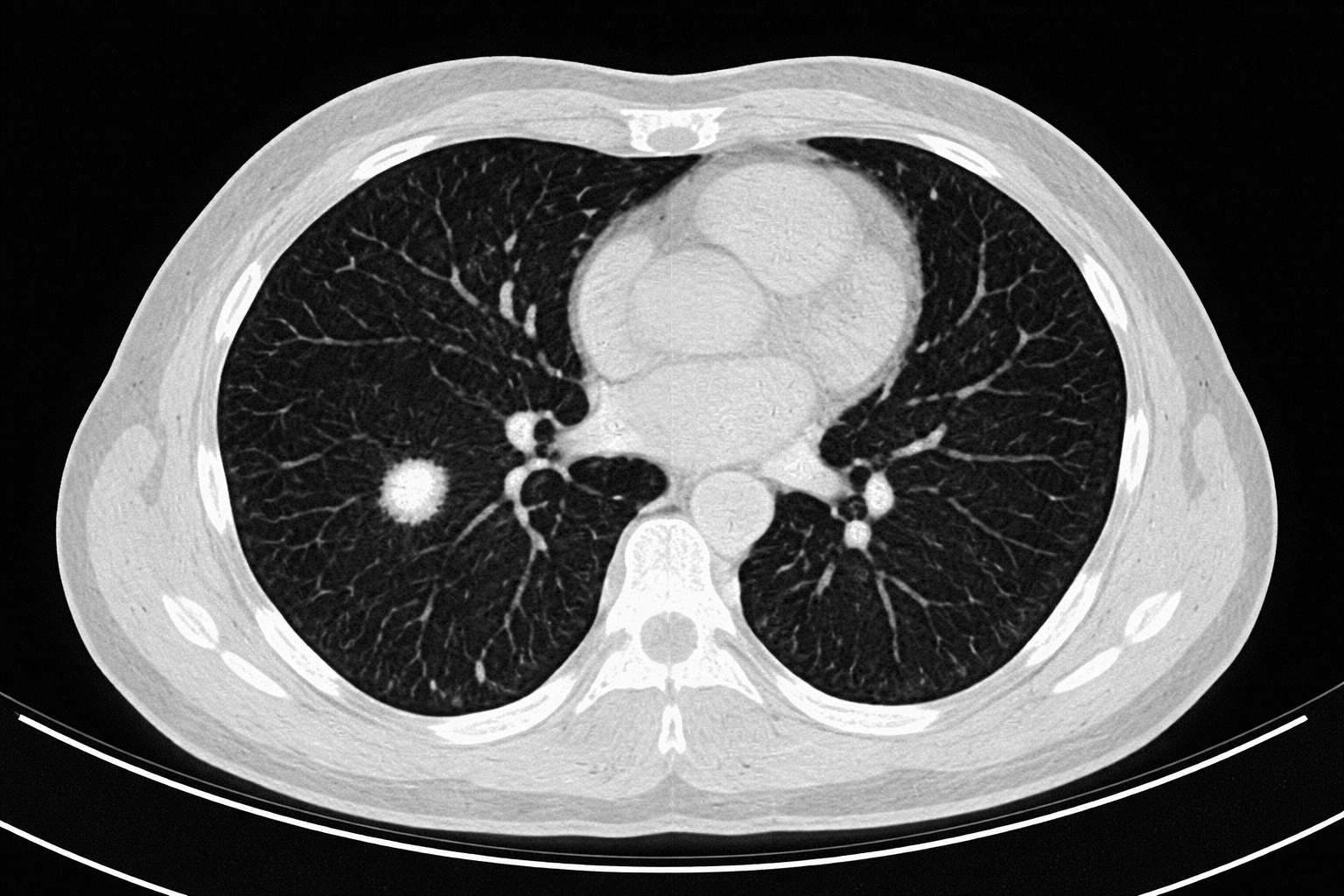 Incidental Pulmonary Nodules: Differentials and Diagnostic Imaging