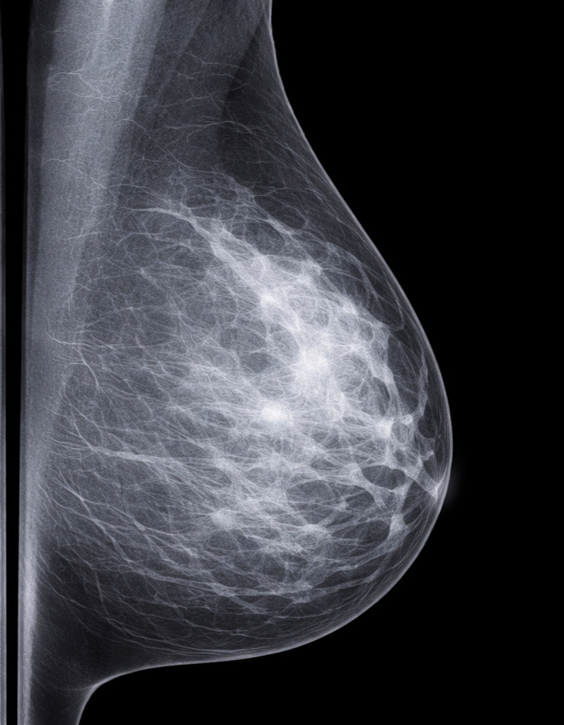 Diagnostic Imaging for a Breast Lump (and other breast concerns)