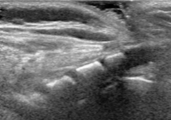 Sacral Dimples and Diagnostic Imaging