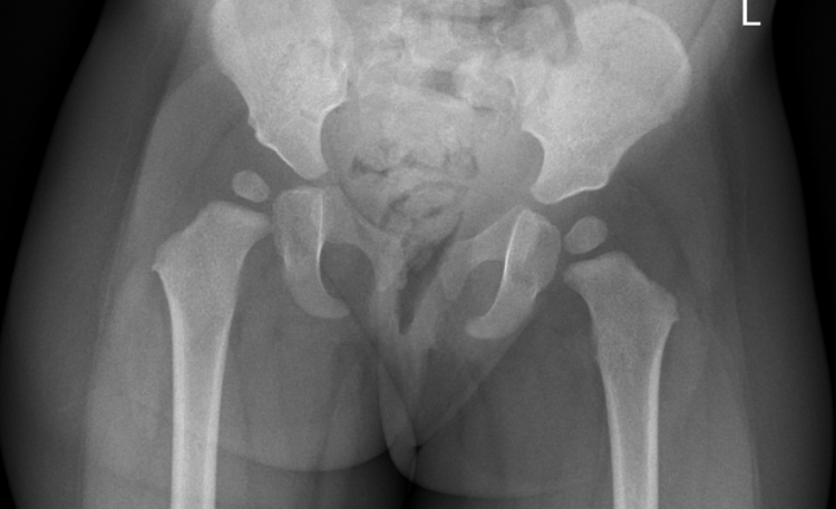Developmental Dysplasia of the Hip (DDH): Diagnostic Imaging with Ultrasound vs. X-Ray