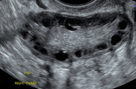 PCOS Differentials and Lab Test Interpretation