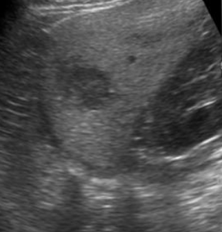 Hepatic Hemangiomas on Ultrasound: How Primary Care Providers Should Interpret This Incidental Liver Lesion