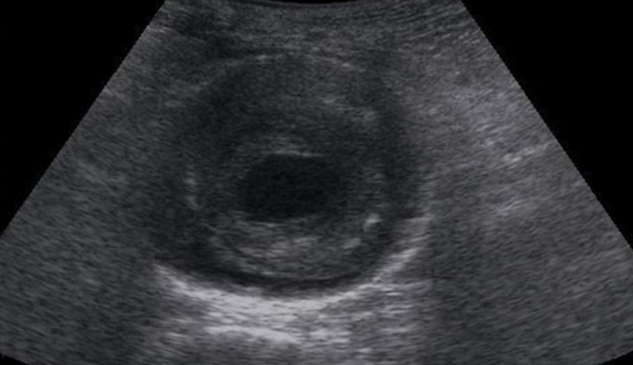Abdominal Aortic Aneurysm (AAA) Screening: Guidelines, Risks, and Follow-Up