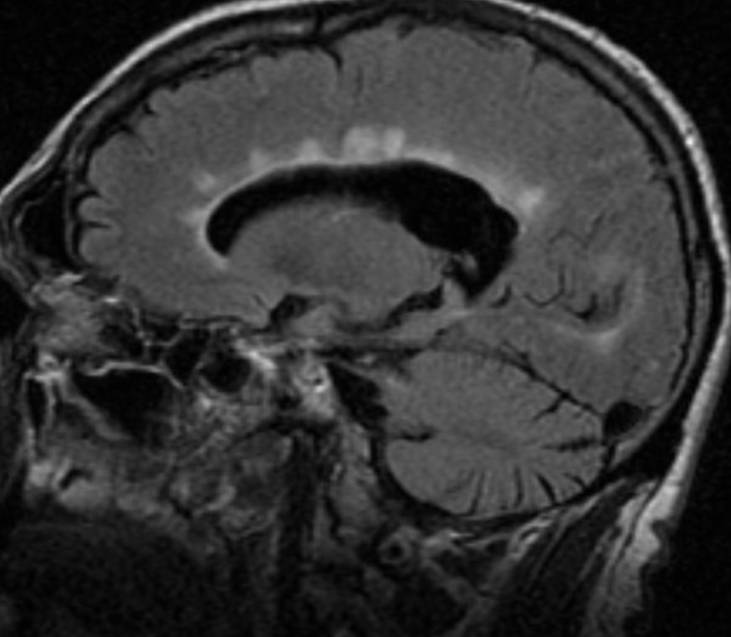 Multiple Sclerosis Diagnosis: MRI Findings, Imaging Protocols, and Interpretation Pearls for Clinicians