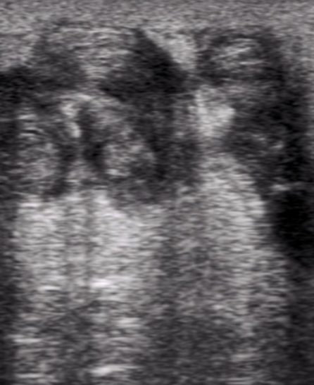 Superficial Thrombophlebitis: Diagnosis, Ultrasound Imaging, and Management in Primary Care