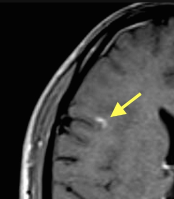 right frontal lobe, a juxtacortical lesion