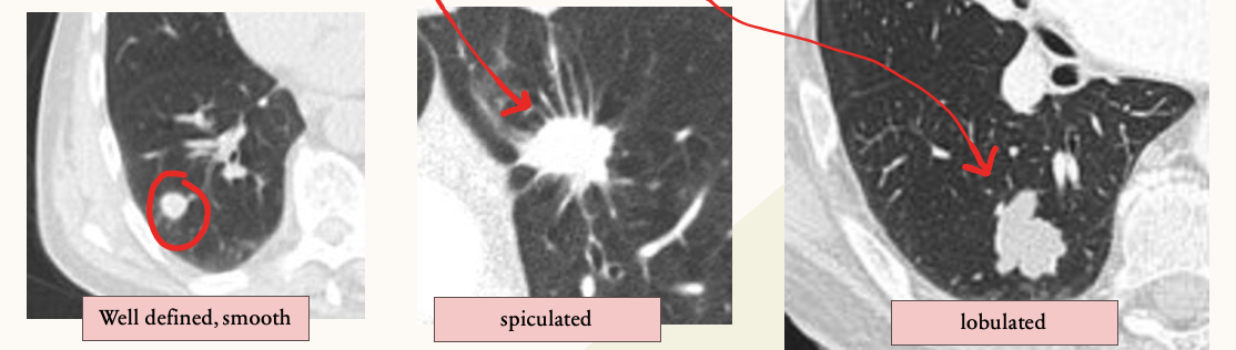 examples of well-defined, smooth, spiculated, an lobulated pulmonary nodules