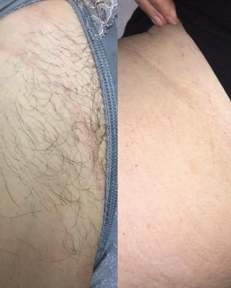 Smart Diode Laser Hair Removal