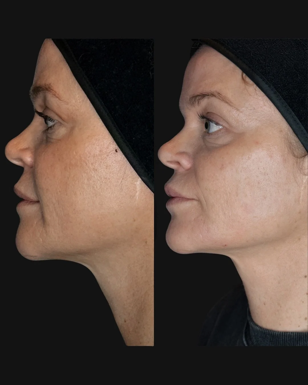 Diskret lyft och fastare hud med behandlingen som alla (speciellt 40+are) &auml;lskar! 

HARMONYCA: 
✔️Fastare hud
✔️Markerar kindben och k&auml;klinje 
✔️F&ouml;rb&auml;ttrad hudton
✔️F&ouml;rb&auml;ttring av veck och linjer 
✔️Direkt resultat
✔️L&a