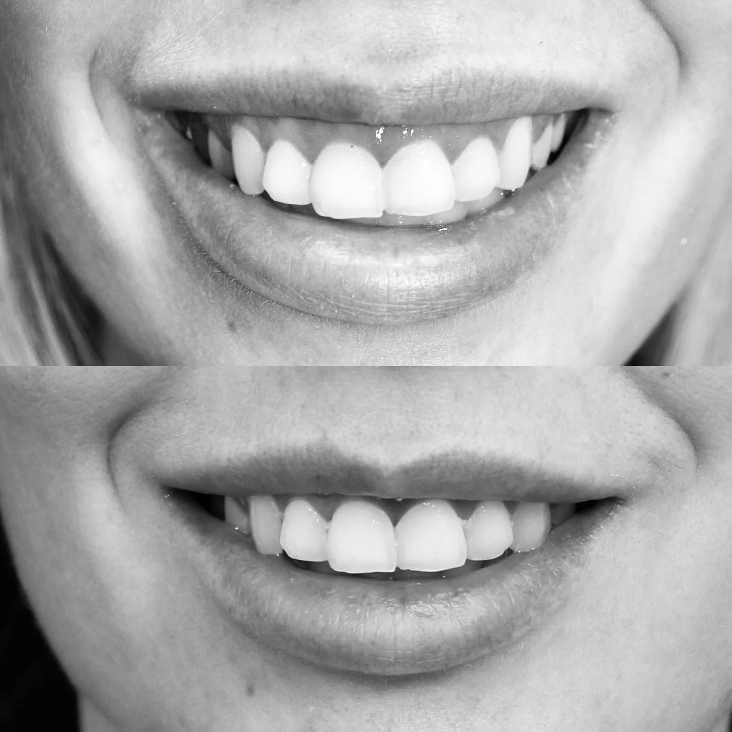 From gummy smile to yummy smile. 

#toxonthego #toxgroup #gummysmile #subtleenhancement #itsinthedetails #smile #beautifulsmile #sk&ouml;nhetsbehandling&ouml;stermalm #injektonsbehandling #toxontheroll #abonnemang #dropin