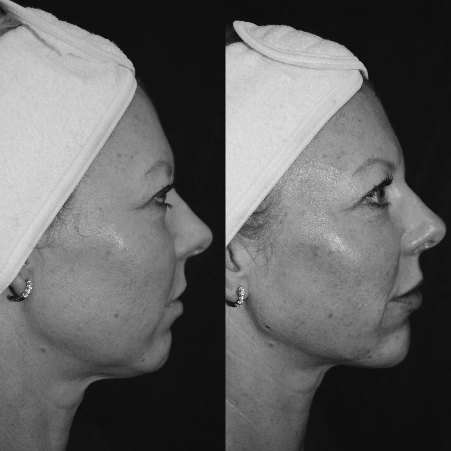 Behandling av haka &amp; en fint balanserad profil.