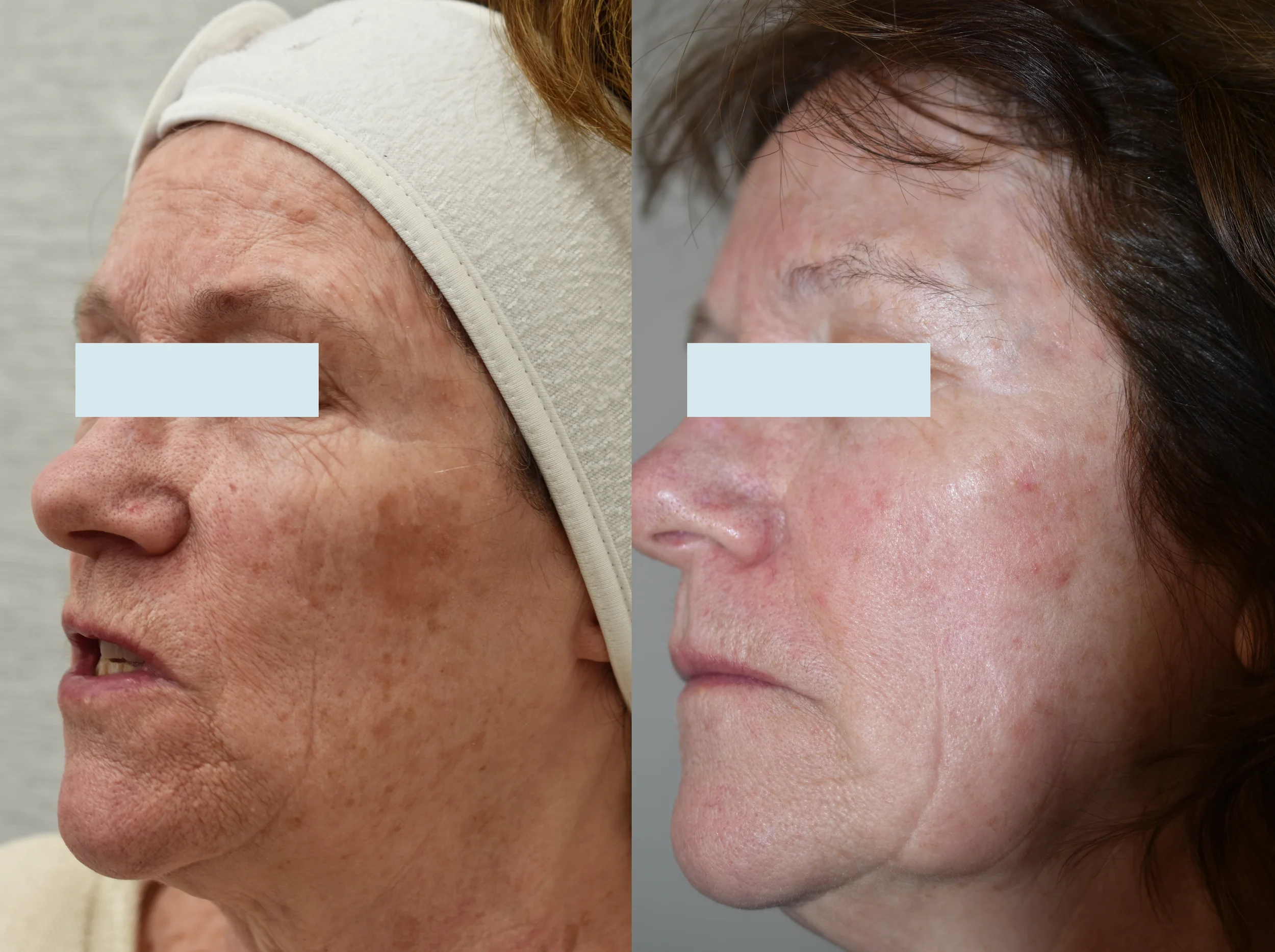 clearplus Ablative Resurfacing Laser treatment Before and After 2026 Riversdale Dermatology 2 copy.webp