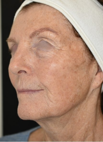 Riversdale Dermatology Aesthetics Treatment Portfolio (6).jpg