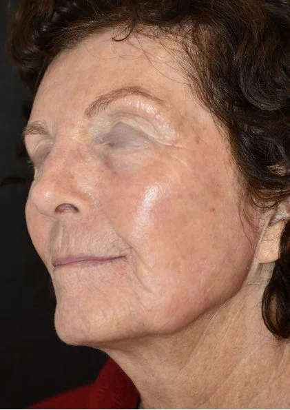 Riversdale Dermatology Aesthetics Treatment Portfolio (7).jpg
