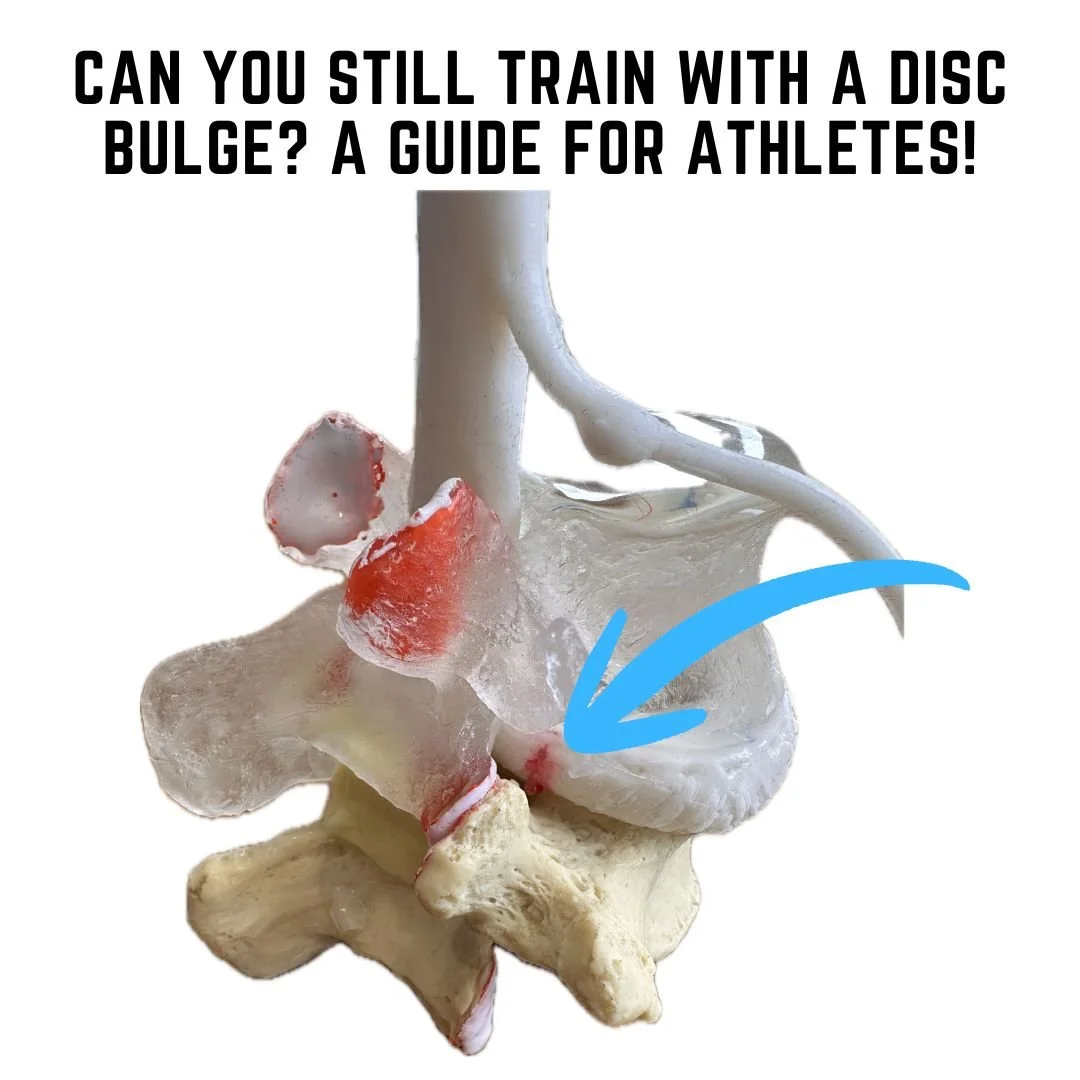 Can You Still Train With a Disc Bulge? A Guide for Athletes