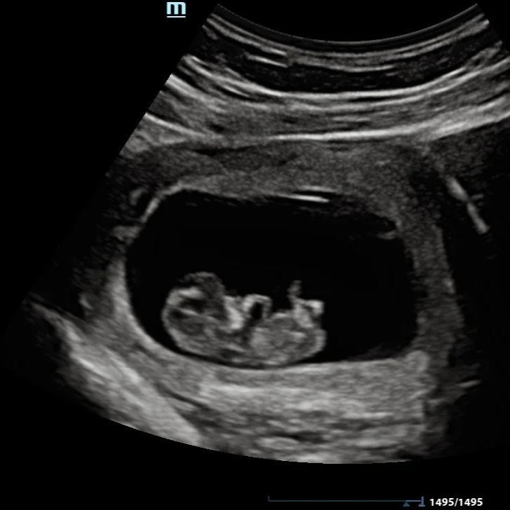 2D ultrasound photo of fetus