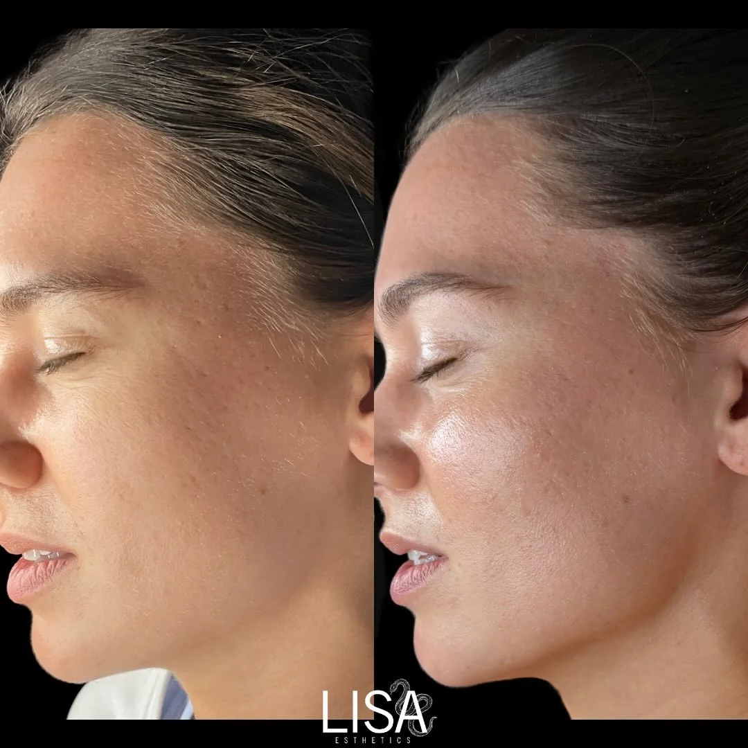 Liquid microneedling has been so, so good to her 🥀

Acne scars softened, fine lines around the eyes and nasolabial folds smoothed, and firmer, tighter skin all around. 

+ @loubeaverbarber on the brows

#esthetician #louisvilleesthetician #acnespeci