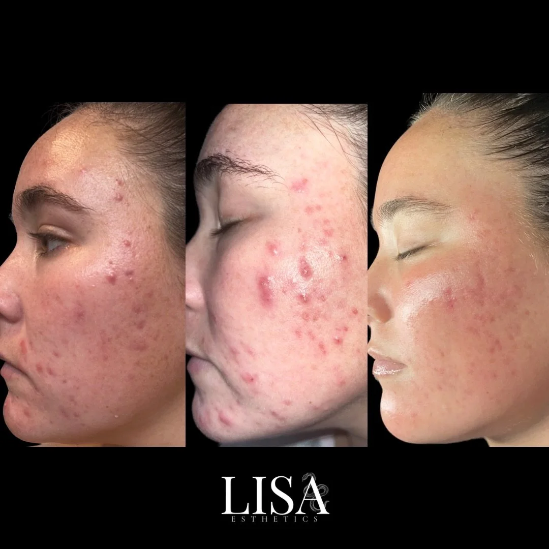 And she&rsquo;s been clear ever since 🪽

Her skin before we started, during the purge, and after. 

#esthetician #louisvilleky #louisvilleesthetician #louisvillekentucky acnespecialist