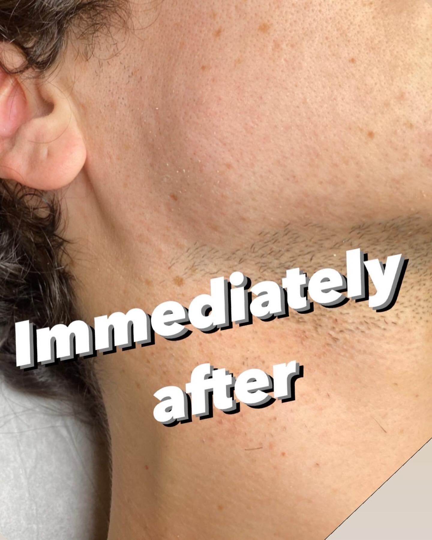Sideburn, neck and partial beard electrolysis! A proper electrologist will prevent over treatment as much as possible via proper skills, training and technique and doing all of the above with care! #electrolysis #permanenthairremoval #facialhair #lgb
