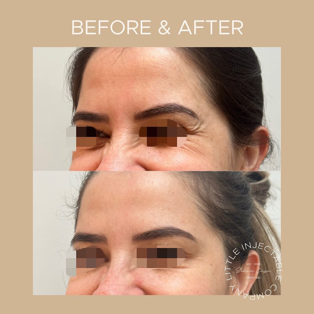 BEFORE AND AFTER: the magic of anti-wrinkle treatments for crow's feet! 🌟 By targeting these delicate lines, we can offer a smoother, more youthful appearance. The benefits? Reduced lines, a rested look, and prevention of deeper wrinkles. Dive into 