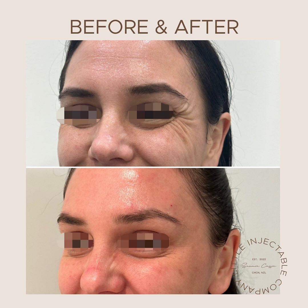 Anti wrinkle results for treating crows feet. 💫