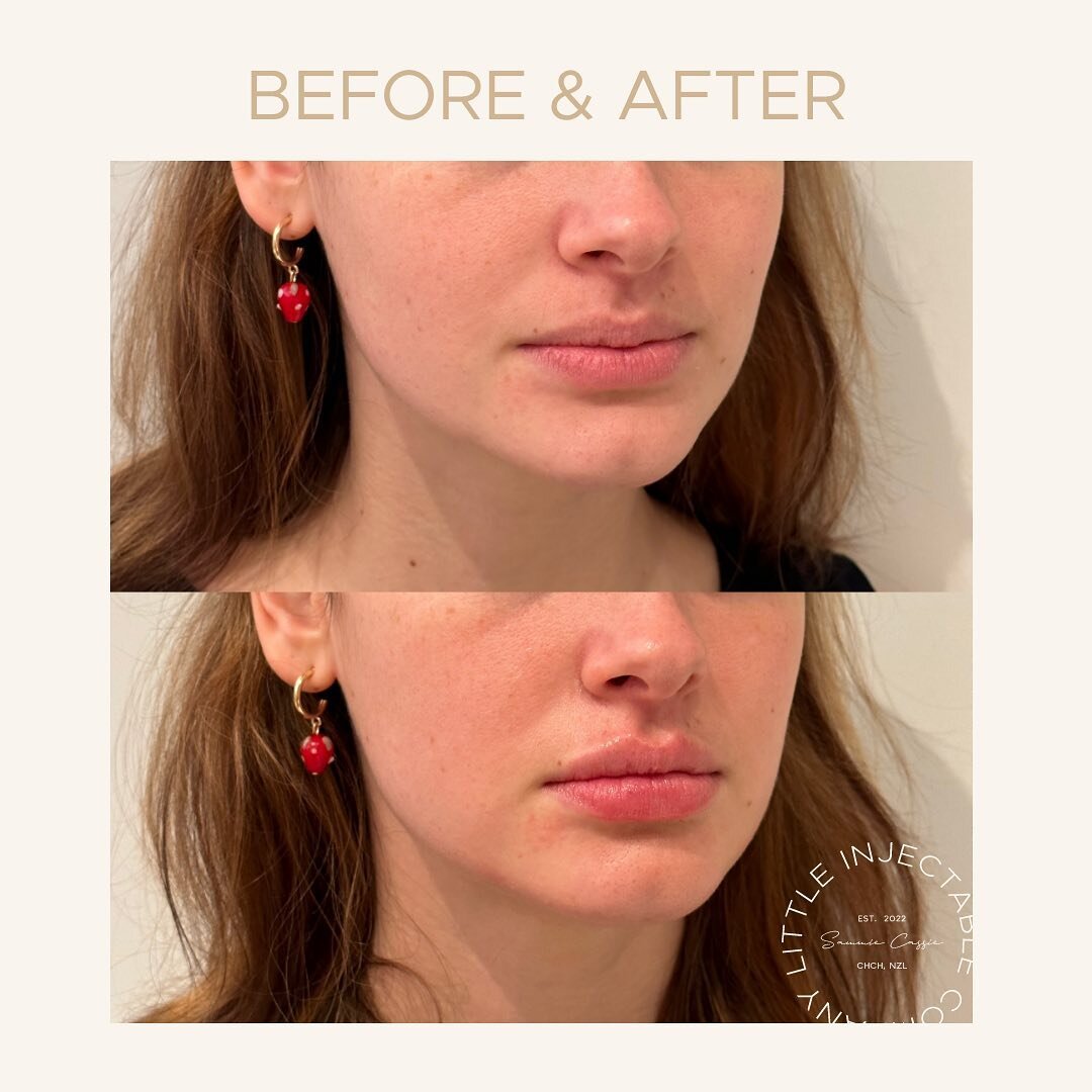 The subtle art of lip enhancement🌟 Our beautification patient desired just a touch more volume and hydration. Using a conservative approach, we added a total of 0.65ml lip filler, creating a beautifully enhanced and hydrated pout. The before and imm