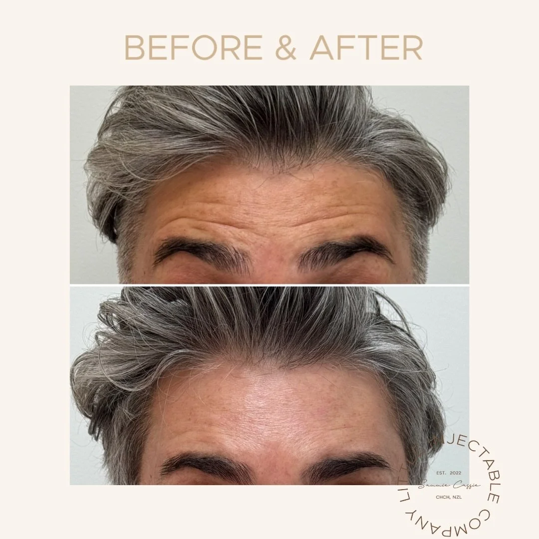 When I first started injecting, I chased zero movement.
Smooth at all costs.

Now? My approach has changed &mdash; especially with male patients.

This is a perfect example of controlled, natural movement.
✔️ Frown softened
✔️ Skin smoother
✔️ Still 