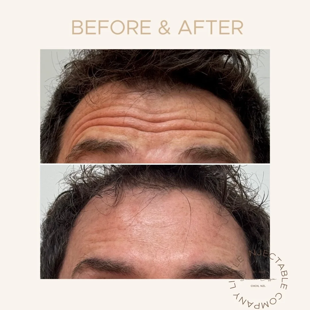 Refreshed. Smoother. Still you.

Subtle anti-wrinkle treatment for a male patient wanting a fresher, more rested look without looking &ldquo;done.&rdquo; The goal is always natural movement, softened lines, and results that still feel like you &mdash