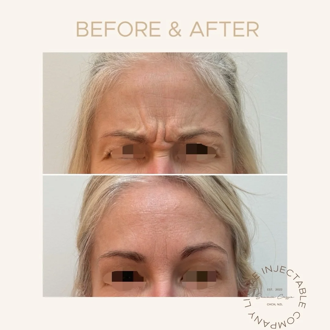 softened, not frozen ✨

Upper face anti-wrinkle treatment targeting:
&mdash; forehead lines
&mdash; frown lines
&mdash; crow&rsquo;s feet

Thoughtful dosing.
Natural movement.
Refreshed appearance.

Book online via Little Injectable Co.

&ndash;&ndas
