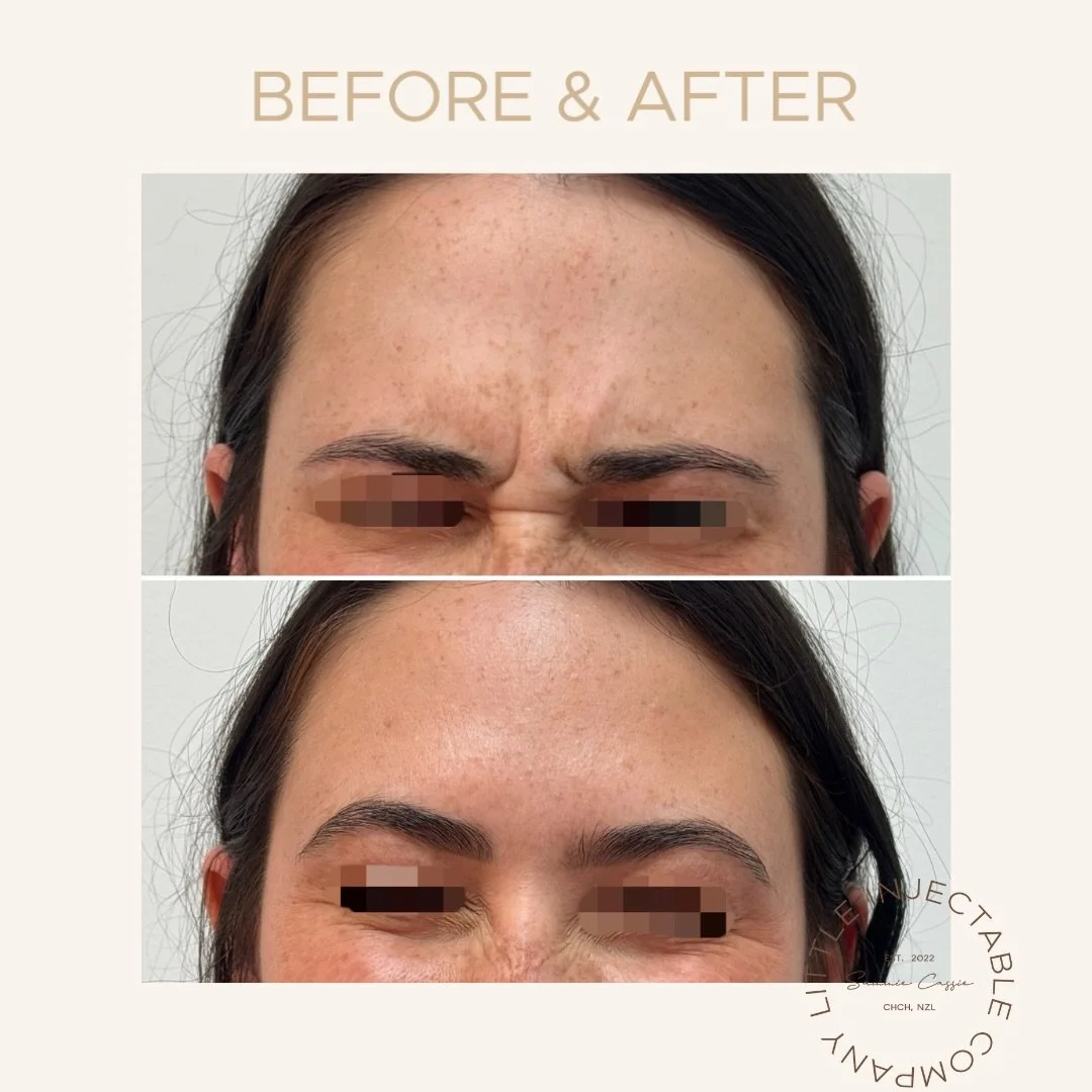 Still you &mdash; just softer, fresher, and more rested.

A subtle treatment to the frown area with a light softening through the crow&rsquo;s feet to maintain natural movement while refreshing the overall appearance.

No frozen faces.
No overdone re