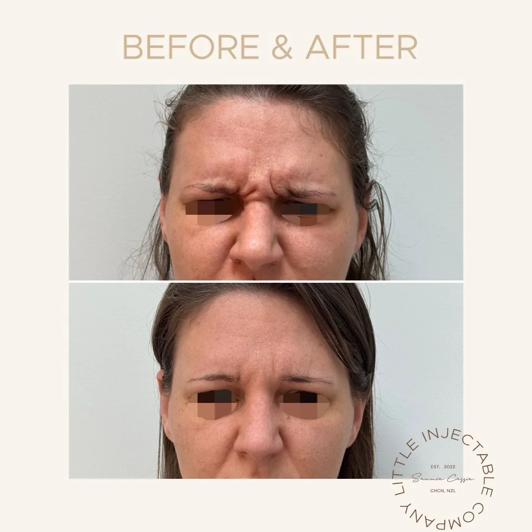 The best injectable results don&rsquo;t announce themselves.

They simply make you look more rested, refreshed, and like yourself again.

Subtle. Balanced. Never overdone.