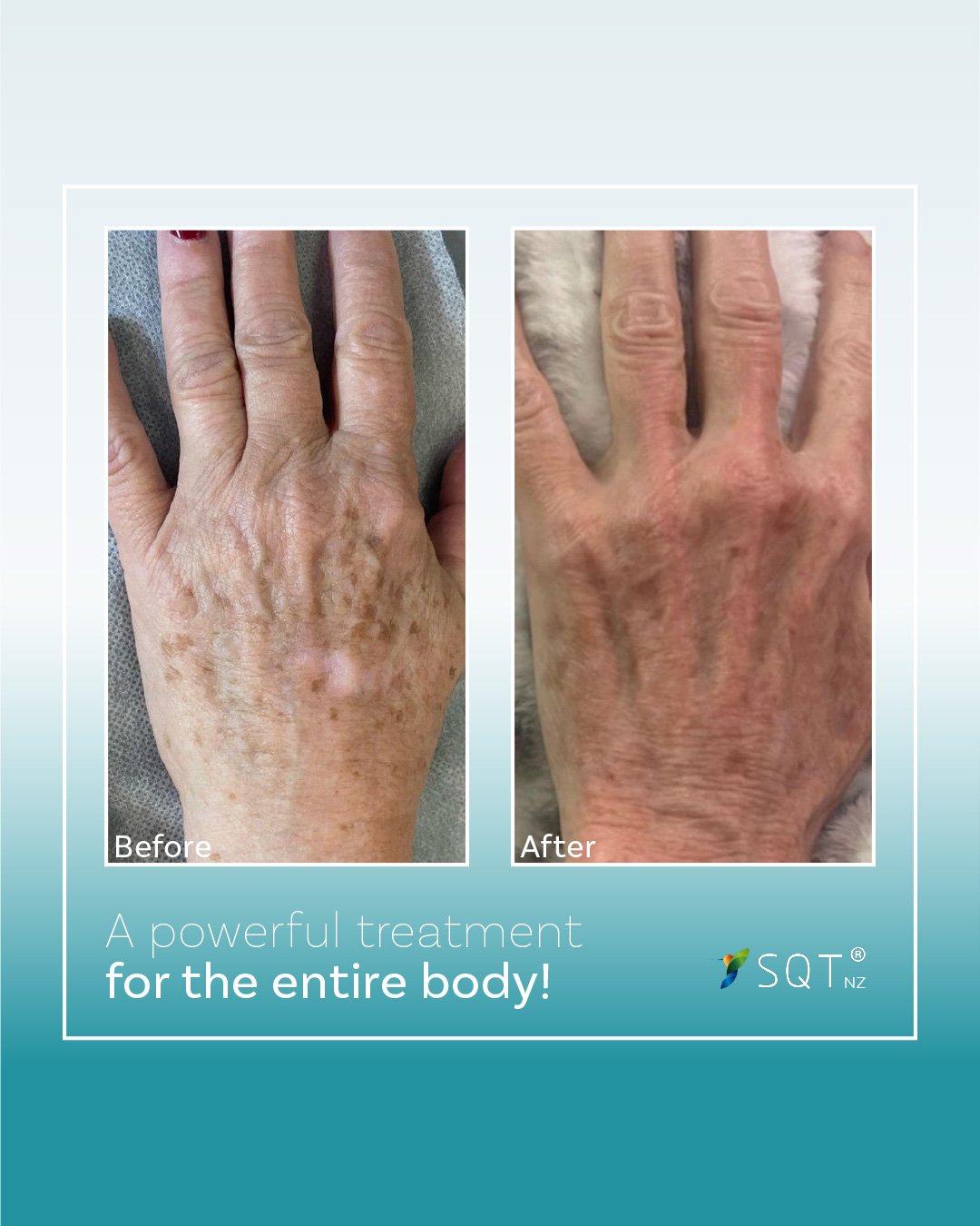 🌱The Power of SQT Bio-Microneedling 🌟

Bio-microneedling is not just for the face&mdash;it&rsquo;s a powerful treatment for the entire body!

Whether it&rsquo;s stubborn stretch marks, scars, or pigmentation, this advanced technique  works wonders 