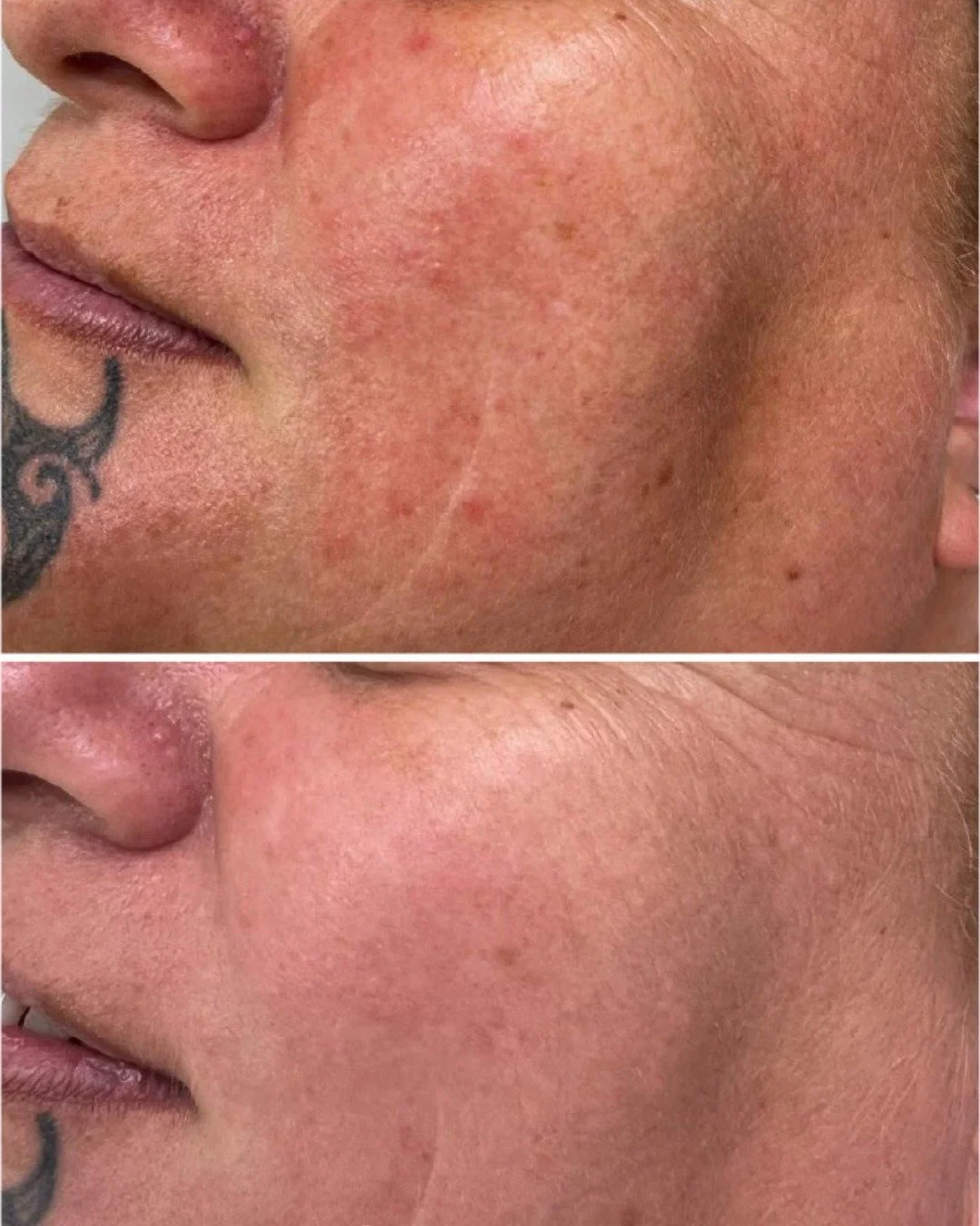 Proof that healthy skin starts from within.

This before and after shows visible improvement in skin tone and texture, with softer fine lines and a smoother, more refined complexion.

SQT Bio Microneedling works by stimulating the skin&rsquo;s natura