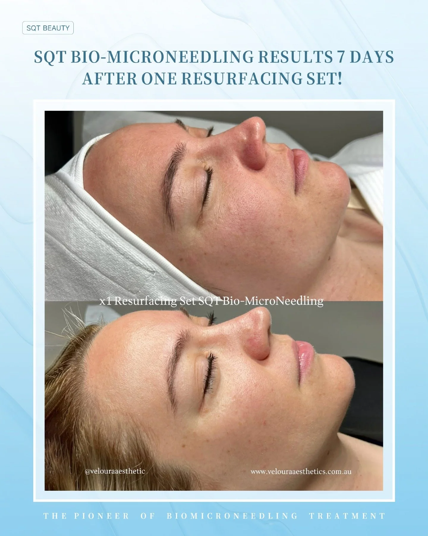 Real results speak louder than anything else. This before and after shows visible skin improvement just 7 days after a single SQT Bio-microneedling Resurfacing Set - with noticeably smoother texture and improved overall skin quality.

For salons, tha