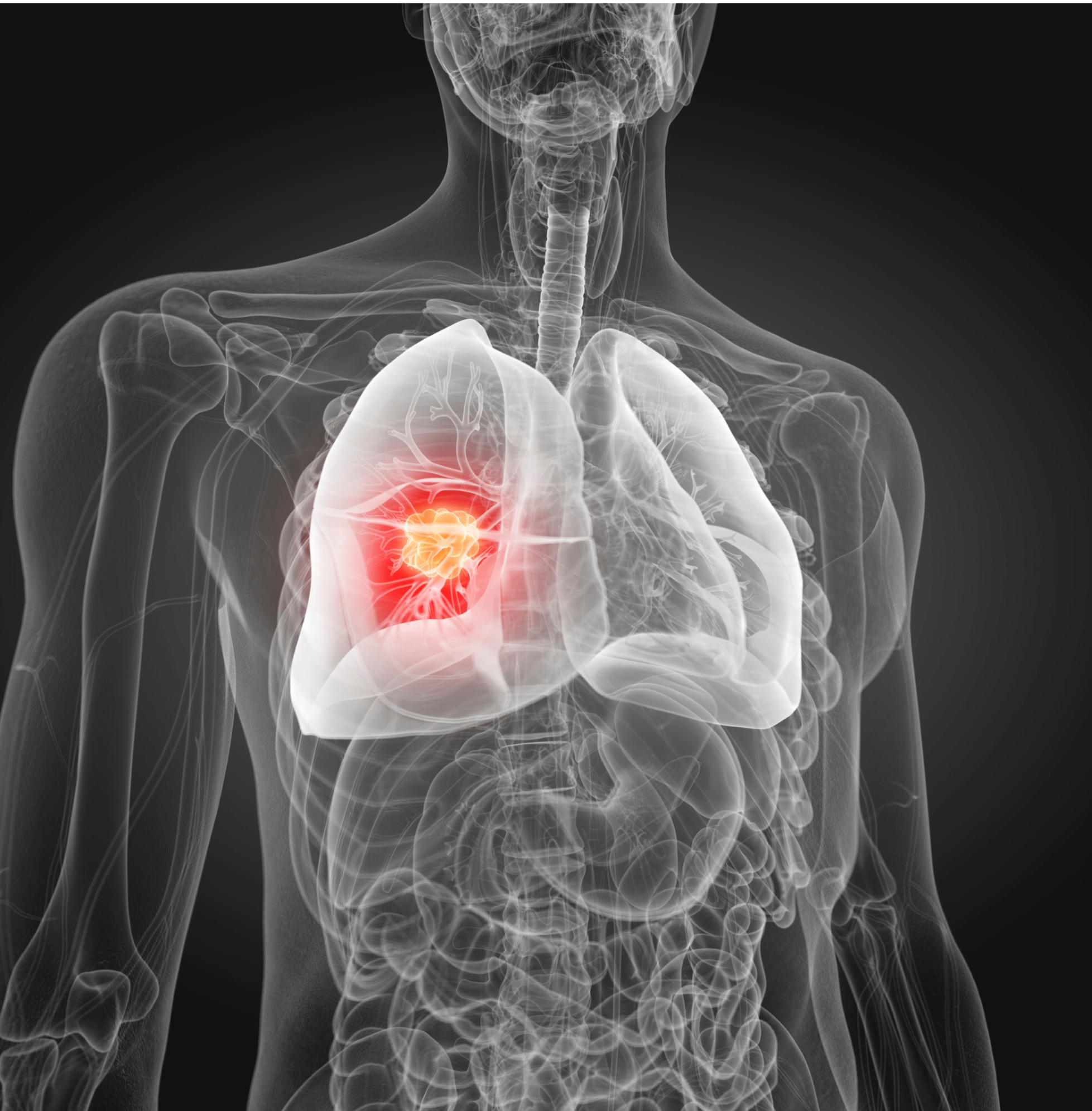 New Hope for HER2-Mutant Lung Cancer: Sevabertinib and Zongertinib Explained