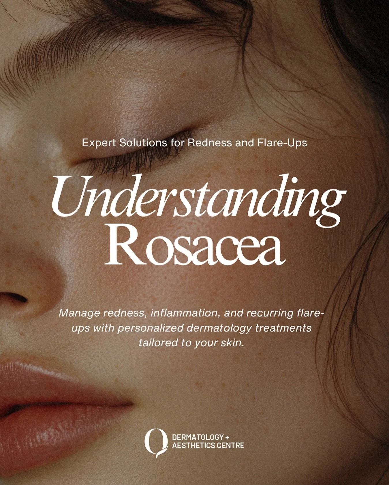 Rosacea can cause persistent redness, visible blood vessels, flare-ups, and discomfort that impact both confidence and daily life. At Q Dermatology + Aesthetics Centre, our expert dermatologists create personalized treatment plans to address your uni