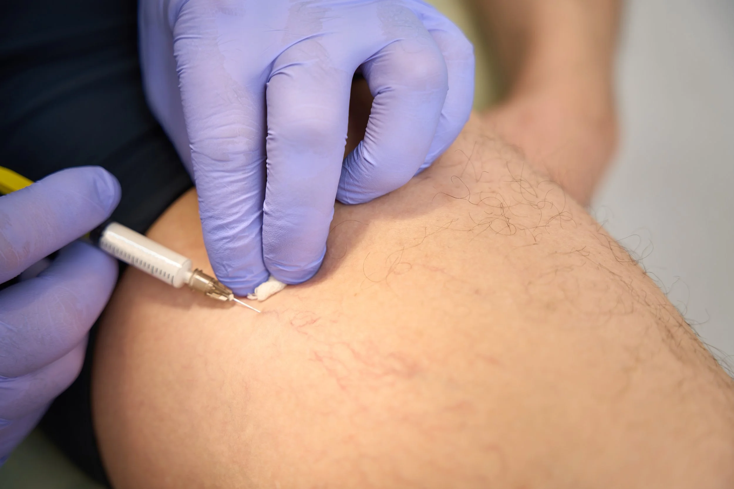 Sclerotherapy