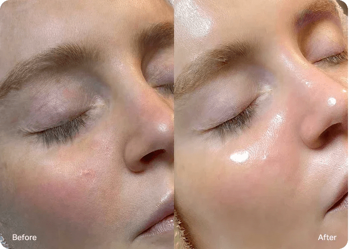 Hydrafacial Results: Before & After Improvements