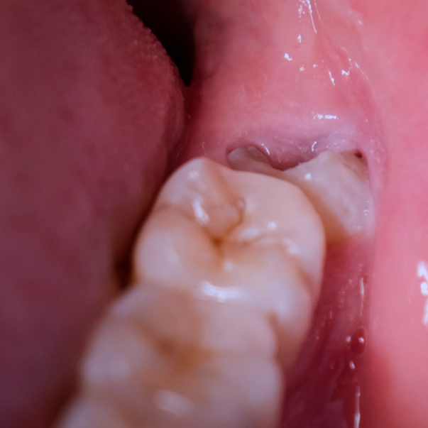 Close-up of the inside of a mouth showing two molar teeth and a partially erupted impacted wisdom tooth with decay at the back, along with part of the tongue and pink gums.