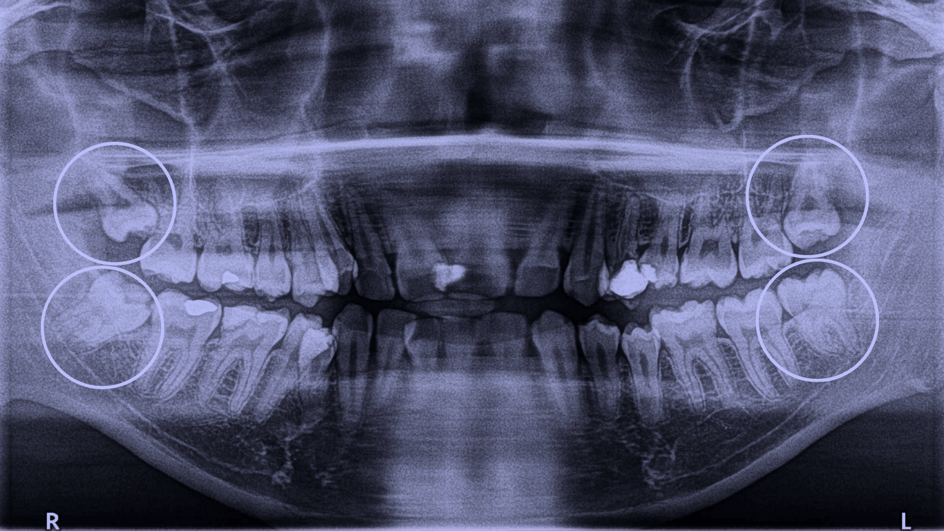 Panoramic dental X-ray showing upper and lower teeth with highlighted impacted wisdom teeth areas in circles, indicating regions of interest or concern in a wisdom teeth evaluation by a surgical dentist.