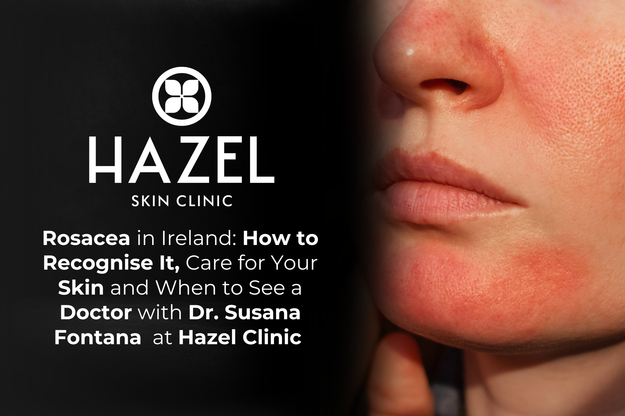 Rosacea in Ireland: How to Recognise It, Care for Your Skin and When to See a Doctor