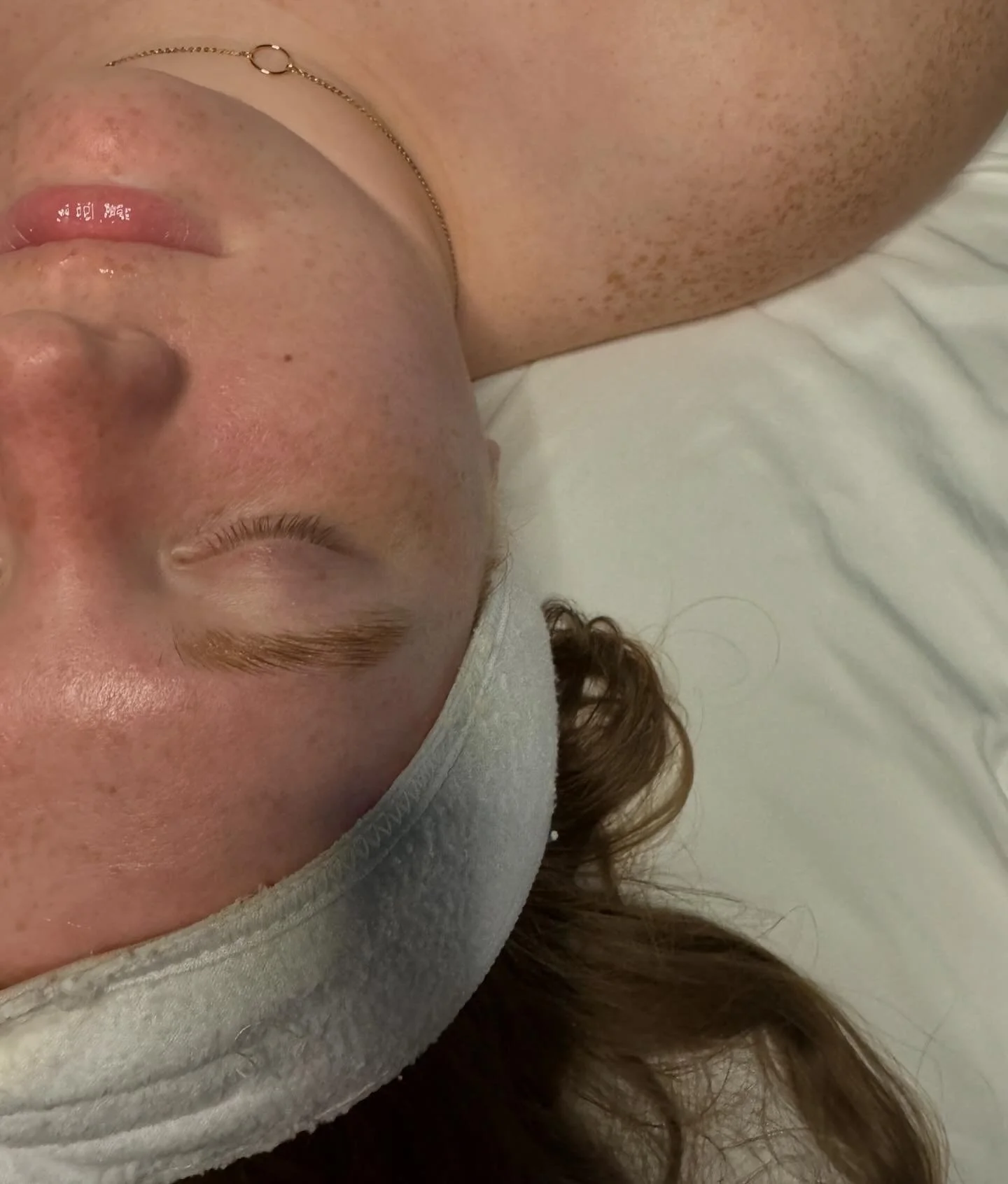 Before &amp; after with that post dermaplane glow ✨  Swipe to see the dead skin &amp; blonde fuzzies I removed!