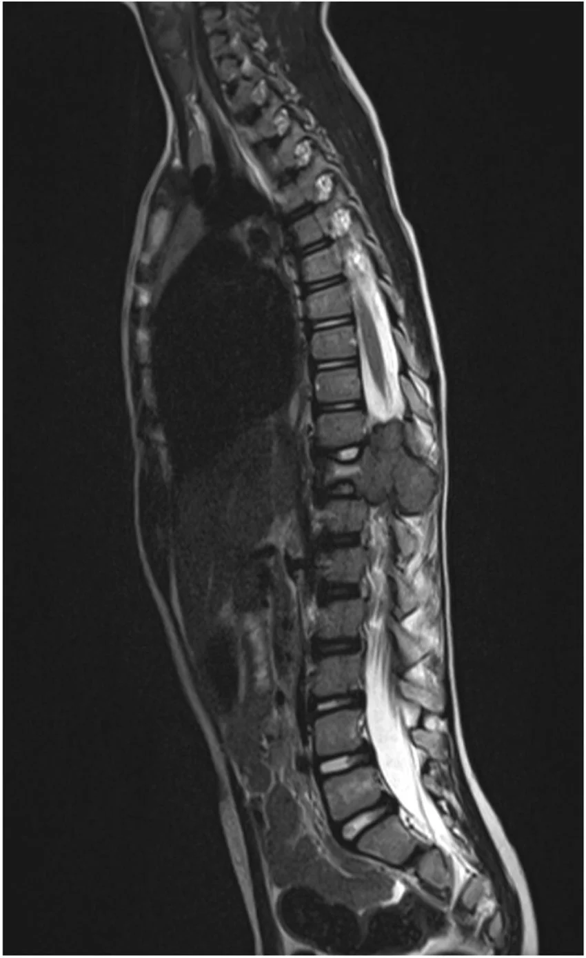 Spine-MRI-of-a-5-year-old-child-with-JXG-acquired-at-the-time-of-hospital-admission-This.jpg