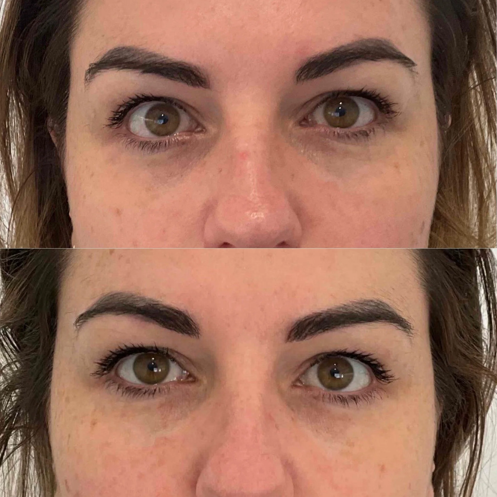 Why Choose Rejuran?  The Ultimate Guide to Under-Eye Rejuvenation in Canberra