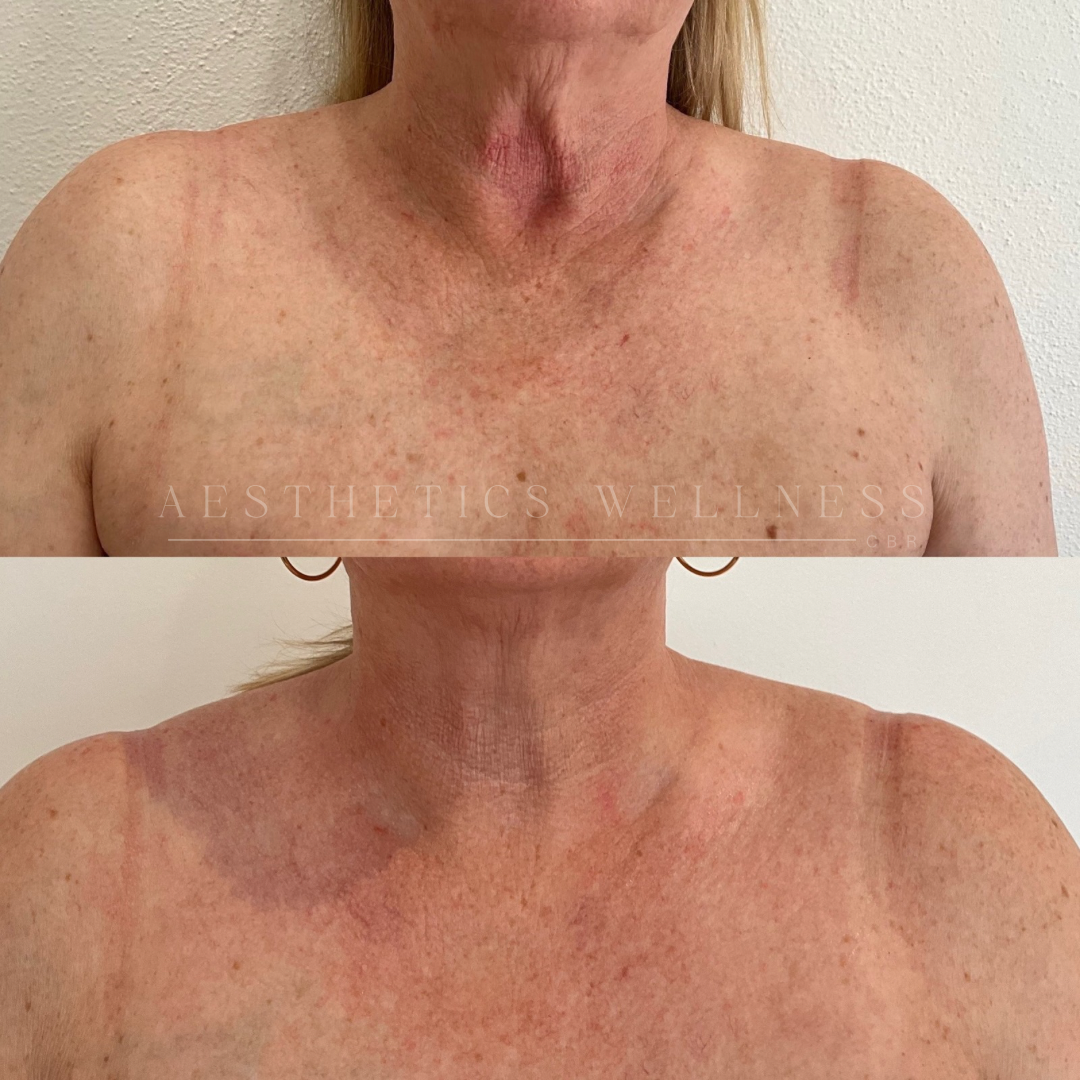 Why Winter is the "Golden Season" for IPL Skin Rejuvenation