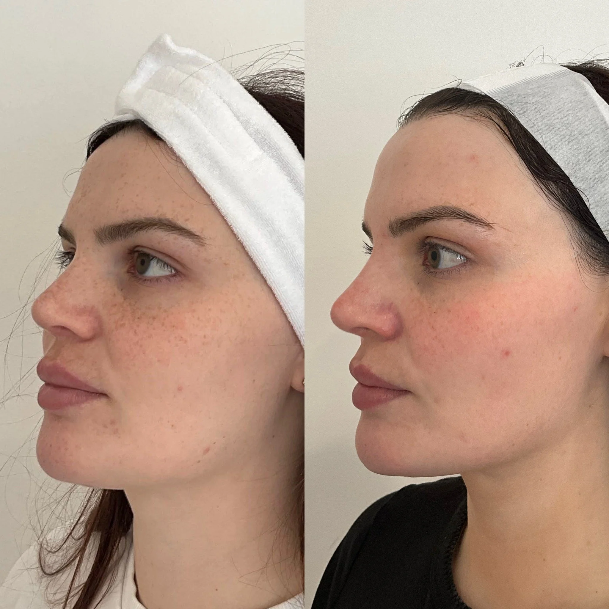 Cosmelan before & after Canberra