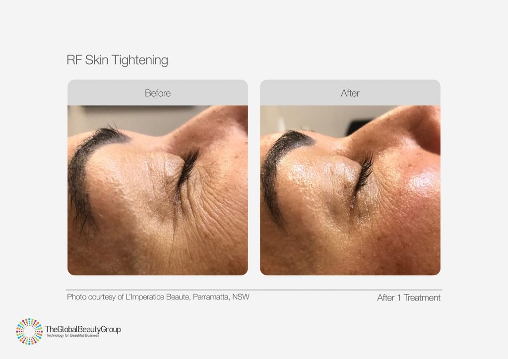 Skin tightening RF crowsfeet